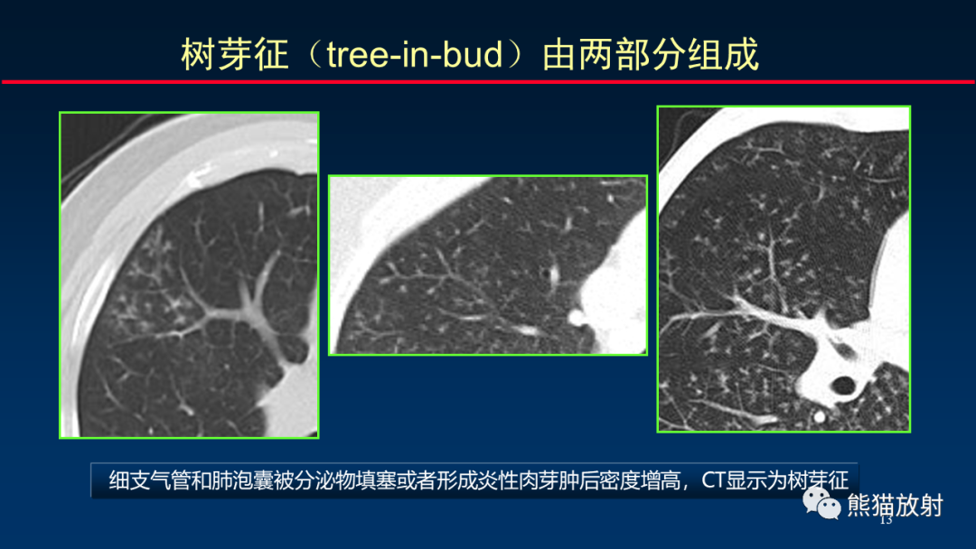 【PPT】HRCT对肺结核细节的观察进展-13