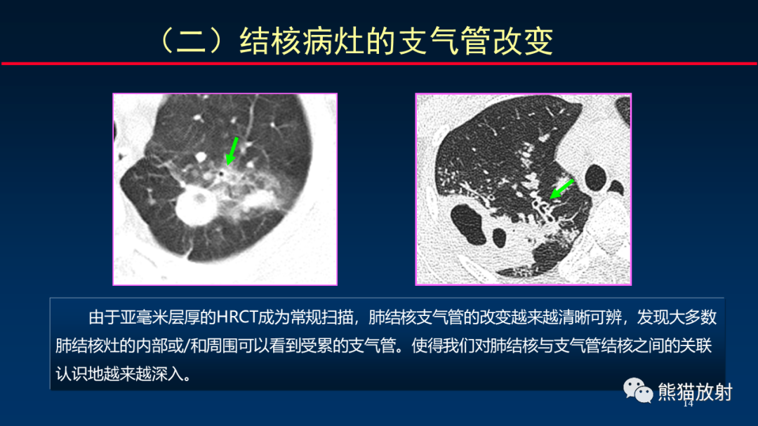 【PPT】HRCT对肺结核细节的观察进展-14