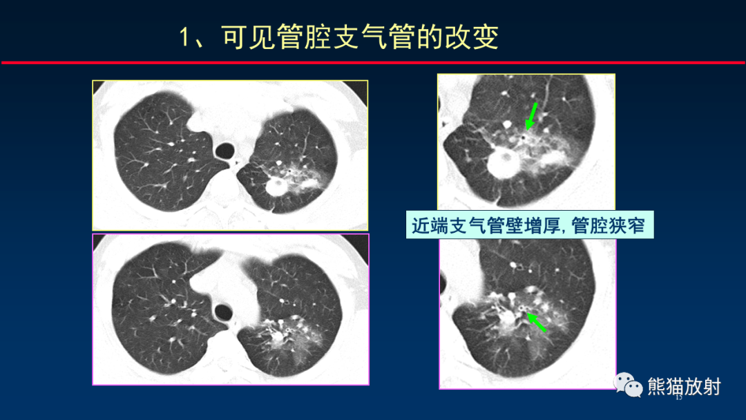 【PPT】HRCT对肺结核细节的观察进展-15