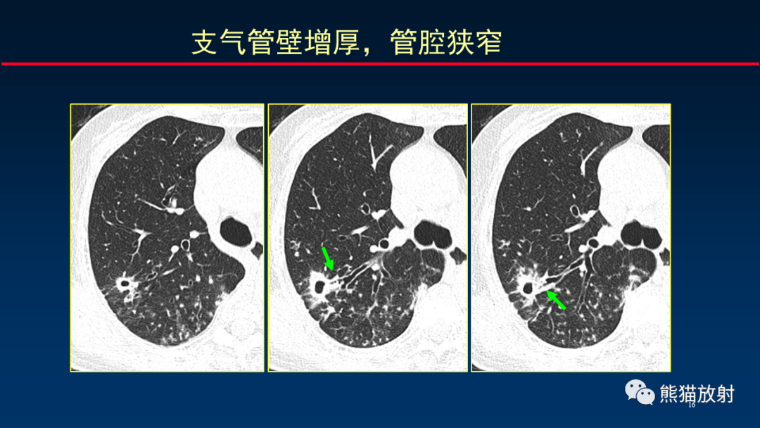 【PPT】HRCT对肺结核细节的观察进展-16
