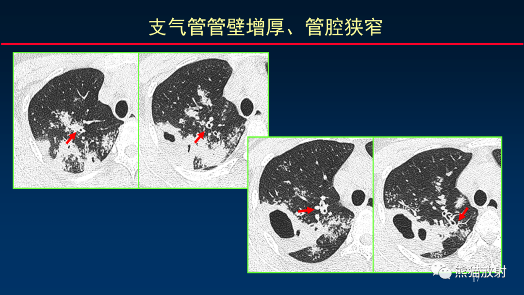 【PPT】HRCT对肺结核细节的观察进展-17