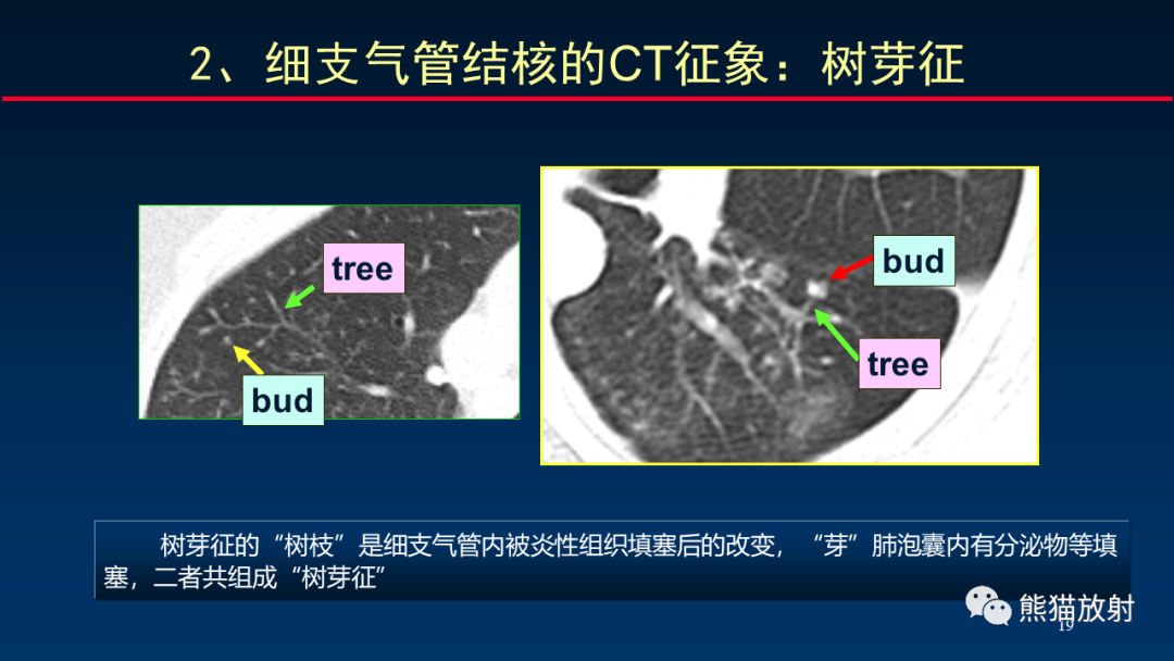 【PPT】HRCT对肺结核细节的观察进展-19
