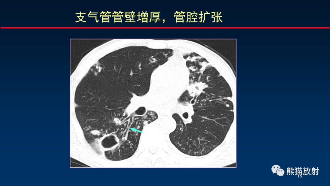 【PPT】HRCT对肺结核细节的观察进展-18