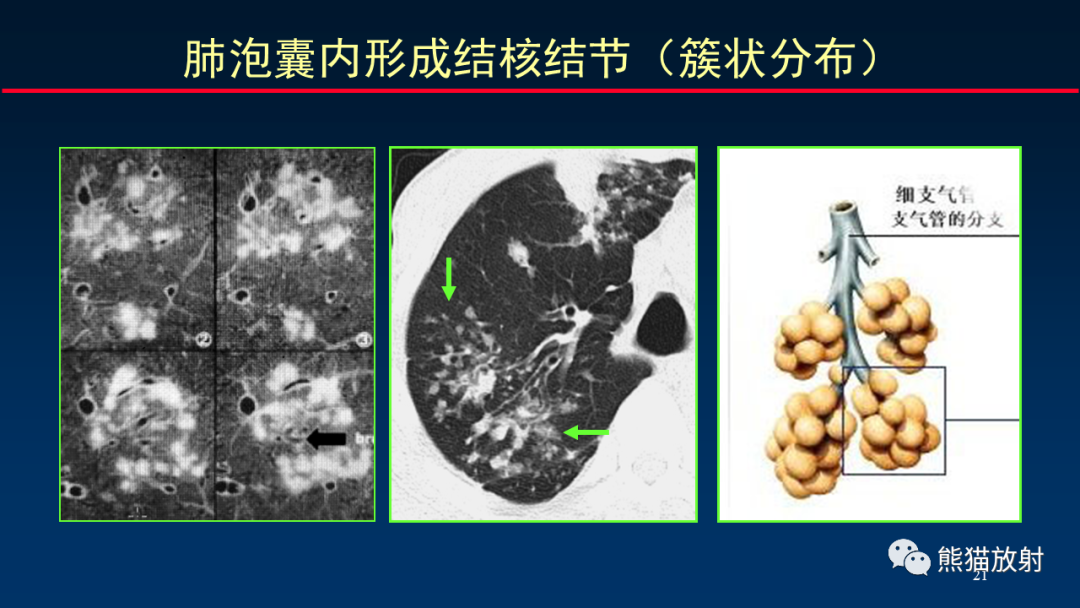 【PPT】HRCT对肺结核细节的观察进展-21