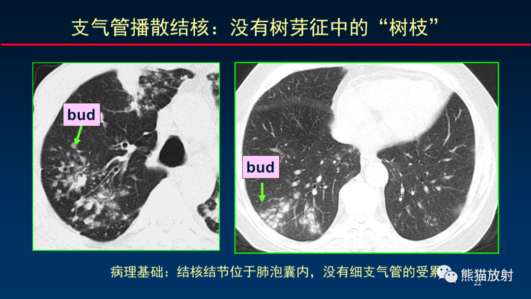 【PPT】HRCT对肺结核细节的观察进展-22