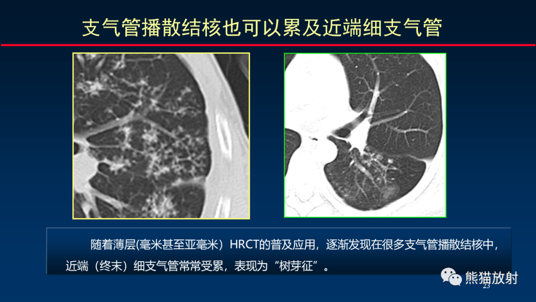 【PPT】HRCT对肺结核细节的观察进展-23
