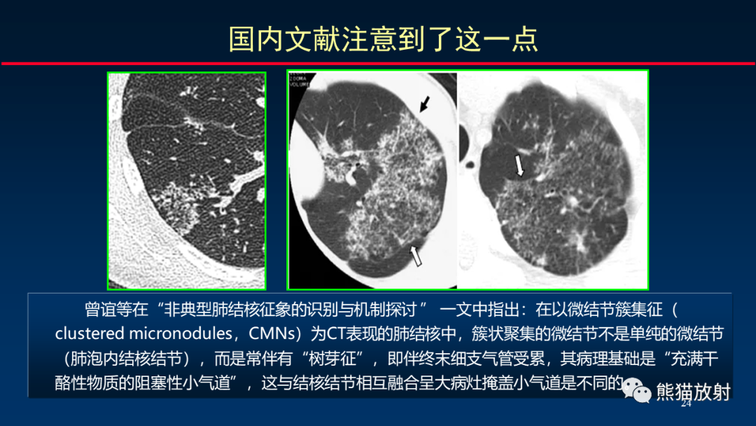 【PPT】HRCT对肺结核细节的观察进展-24