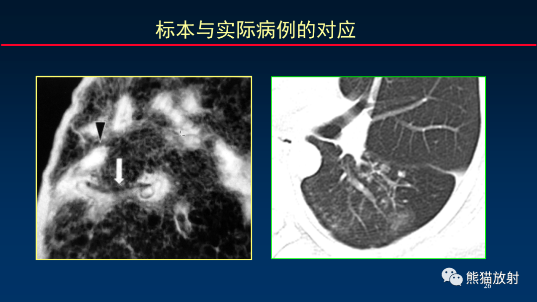 【PPT】HRCT对肺结核细节的观察进展-26