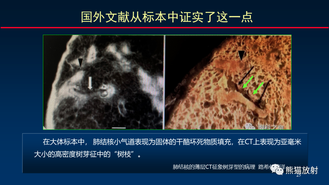 【PPT】HRCT对肺结核细节的观察进展-25