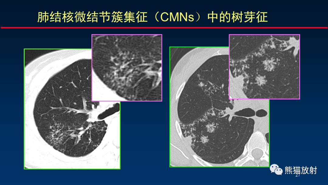 【PPT】HRCT对肺结核细节的观察进展-27