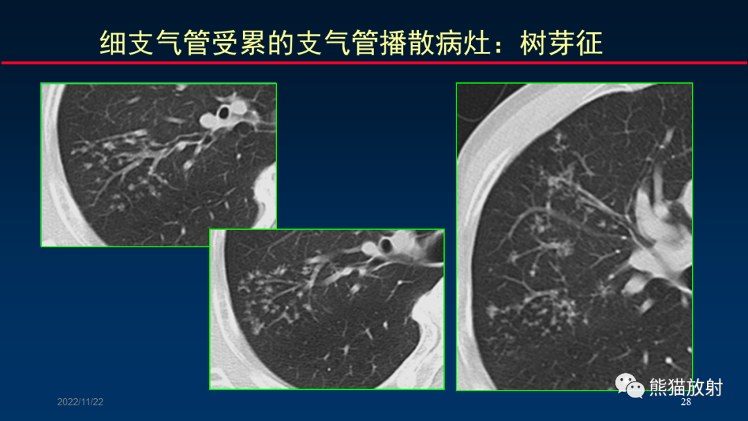【PPT】HRCT对肺结核细节的观察进展-28