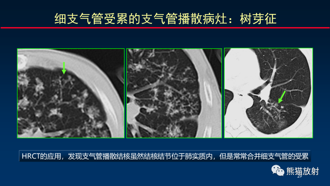 【PPT】HRCT对肺结核细节的观察进展-29