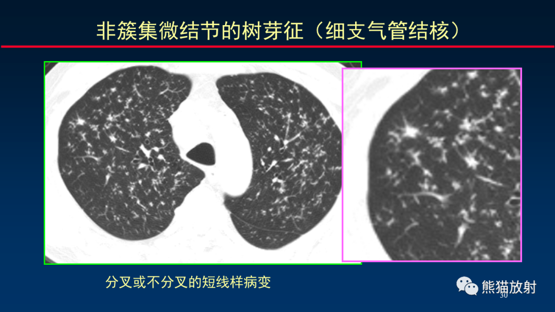 【PPT】HRCT对肺结核细节的观察进展-30