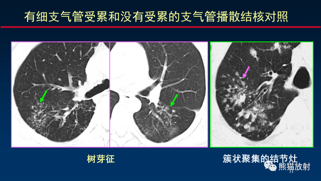 【PPT】HRCT对肺结核细节的观察进展-31