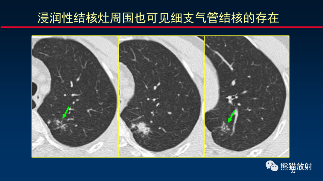 【PPT】HRCT对肺结核细节的观察进展-32