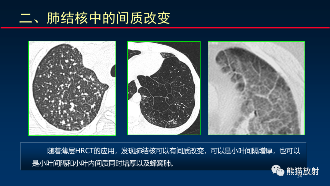 【PPT】HRCT对肺结核细节的观察进展-34