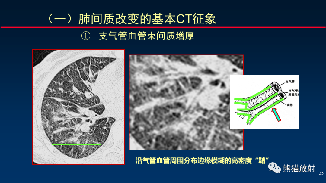 【PPT】HRCT对肺结核细节的观察进展-35