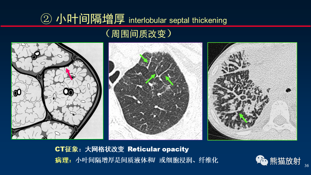 【PPT】HRCT对肺结核细节的观察进展-36
