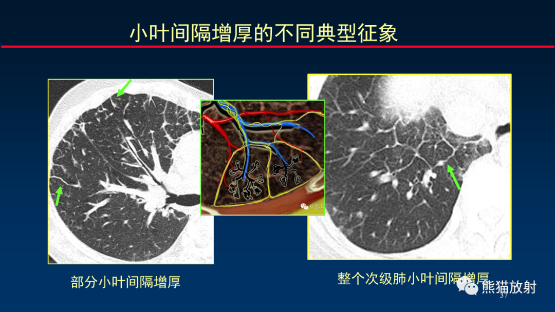 【PPT】HRCT对肺结核细节的观察进展-37