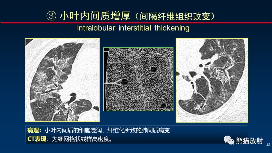 【PPT】HRCT对肺结核细节的观察进展-38