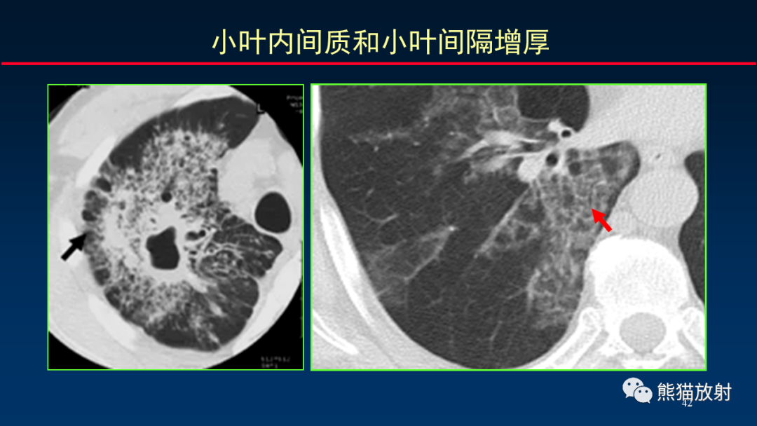 【PPT】HRCT对肺结核细节的观察进展-42