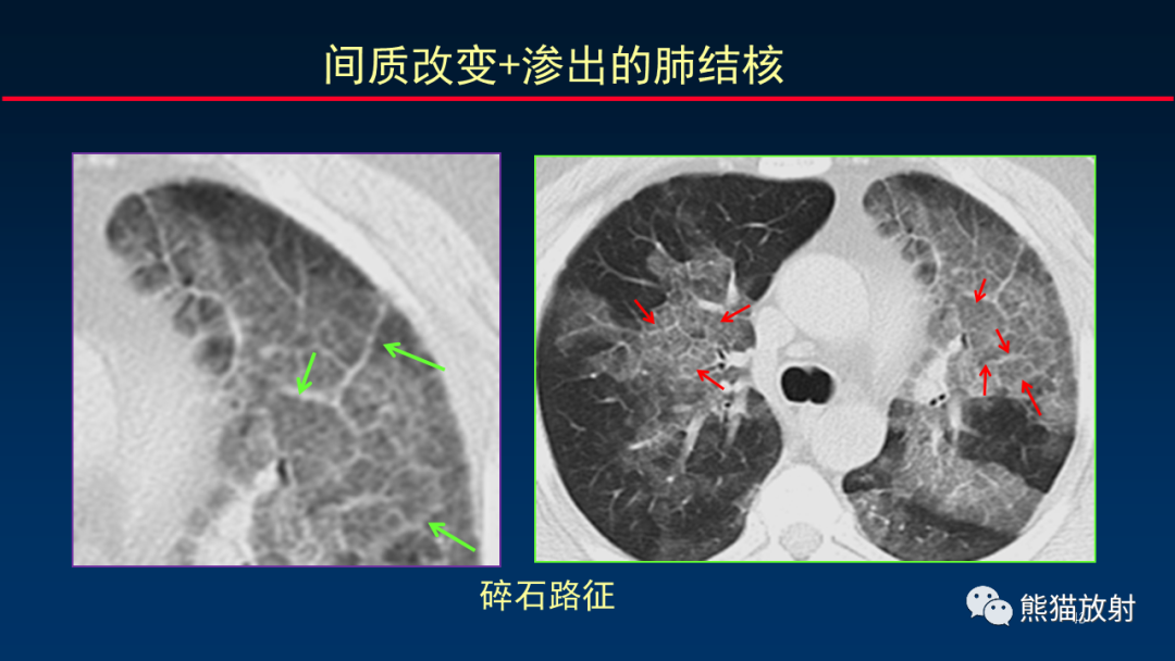 【PPT】HRCT对肺结核细节的观察进展-43