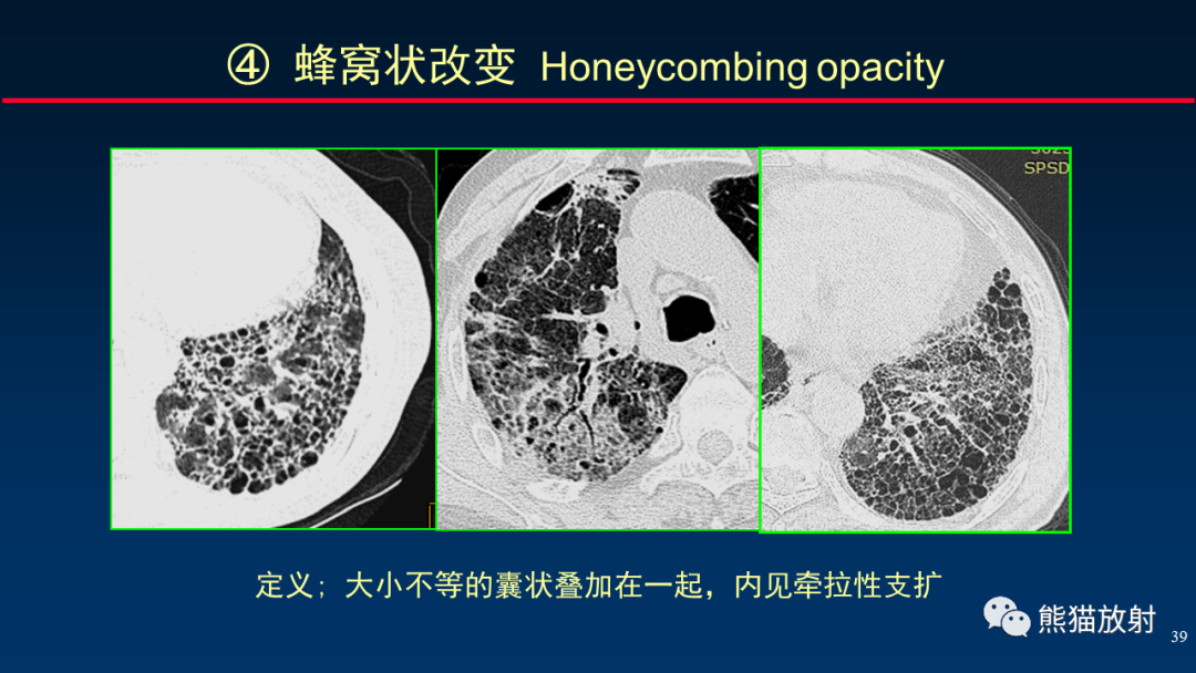 【PPT】HRCT对肺结核细节的观察进展-39