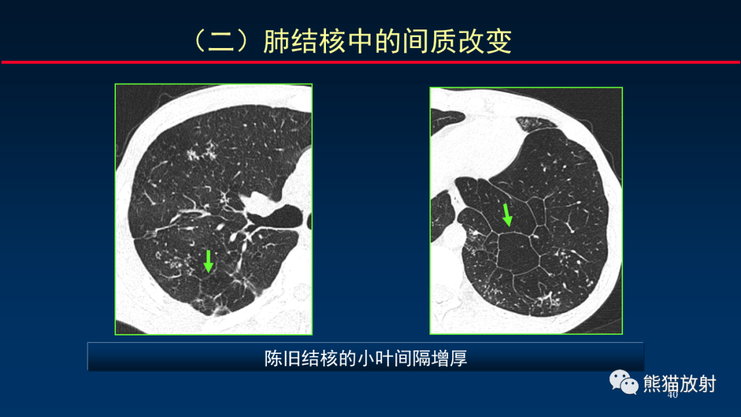 【PPT】HRCT对肺结核细节的观察进展-40