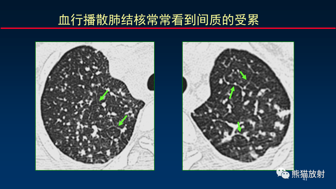 【PPT】HRCT对肺结核细节的观察进展-41