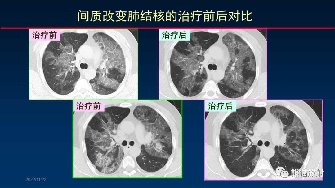 【PPT】HRCT对肺结核细节的观察进展-44