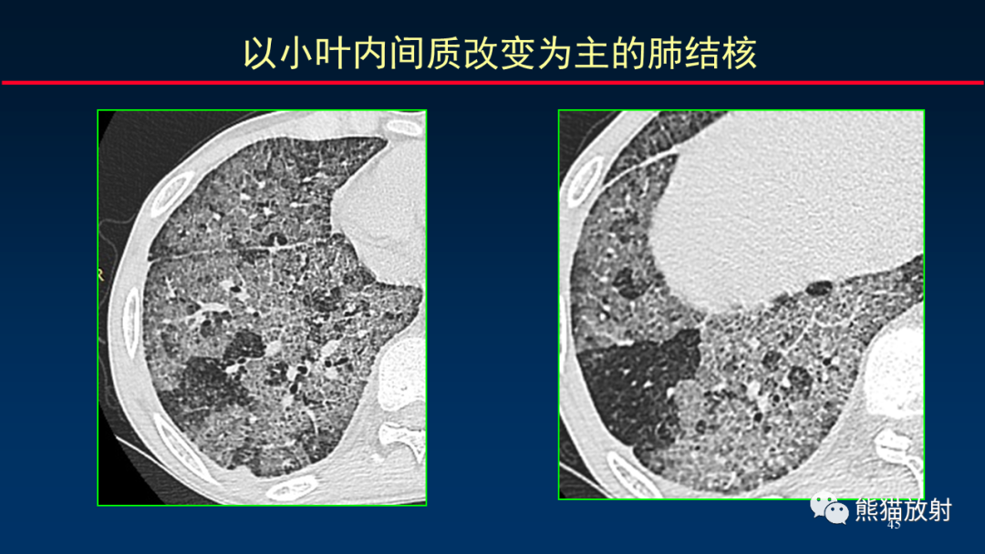 【PPT】HRCT对肺结核细节的观察进展-45