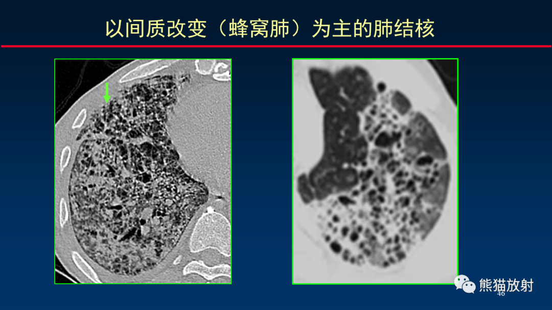 【PPT】HRCT对肺结核细节的观察进展-46
