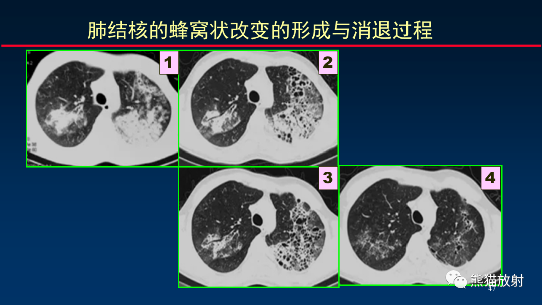 【PPT】HRCT对肺结核细节的观察进展-47