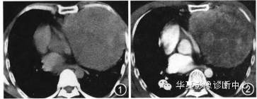 【病例】纵隔原发恶性蝾螈瘤一例