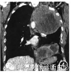 【病例】纵隔原发恶性蝾螈瘤一例