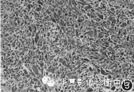 【病例】纵隔原发恶性蝾螈瘤一例