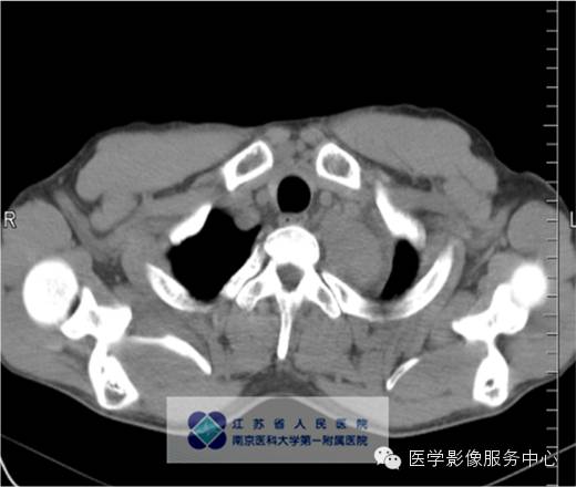 【病例】纵隔巨淋巴增生症1例CT影像表现