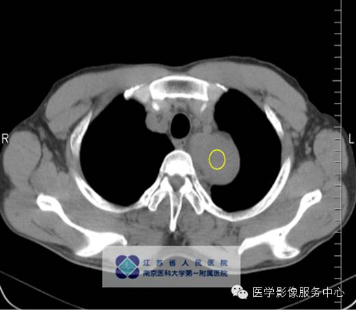 【病例】纵隔巨淋巴增生症1例CT影像表现