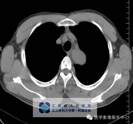 【病例】纵隔巨淋巴增生症1例CT影像表现