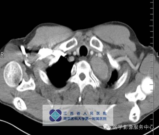 【病例】纵隔巨淋巴增生症1例CT影像表现