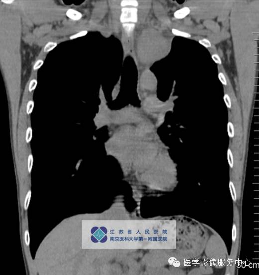【病例】纵隔巨淋巴增生症1例CT影像表现