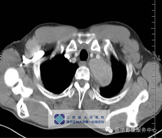 【病例】纵隔巨淋巴增生症1例CT影像表现