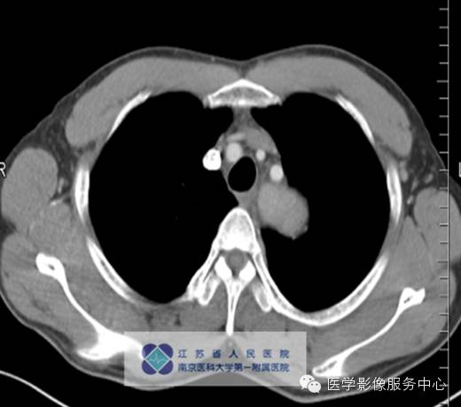 【病例】纵隔巨淋巴增生症1例CT影像表现