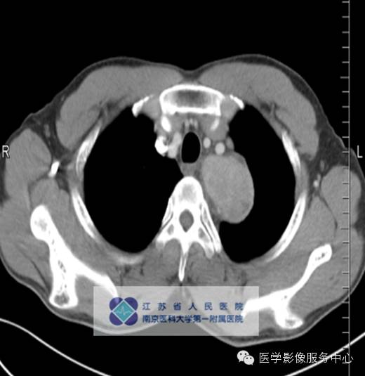 【病例】纵隔巨淋巴增生症1例CT影像表现