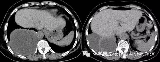 【病例】右侧胸腔黏液性脂肪肉瘤1例