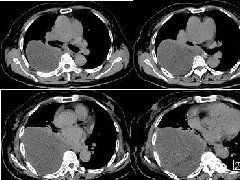 右侧胸腔黏液性脂肪肉瘤1例CT影像表现