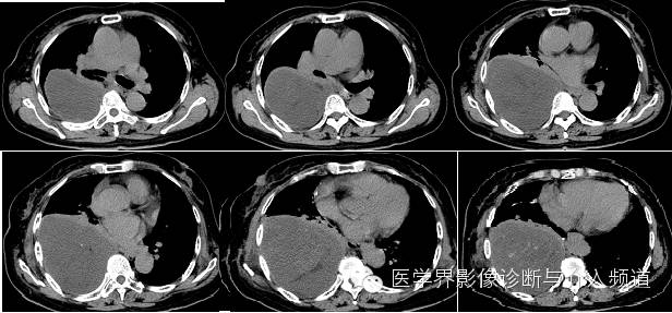 【病例】右侧胸腔黏液性脂肪肉瘤1例
