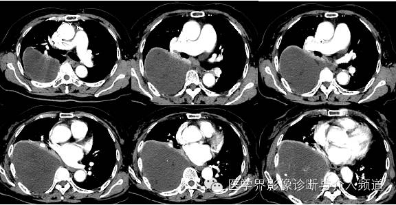 【病例】右侧胸腔黏液性脂肪肉瘤1例
