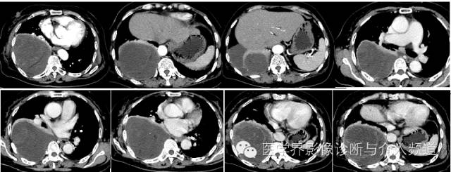 【病例】右侧胸腔黏液性脂肪肉瘤1例