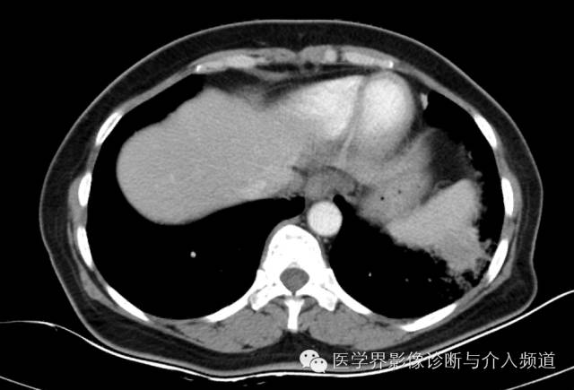 【病例】左下肺硬化性血管瘤1例CT影像表现